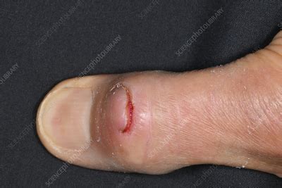 wound  kitchen knife   mans thumb stock image