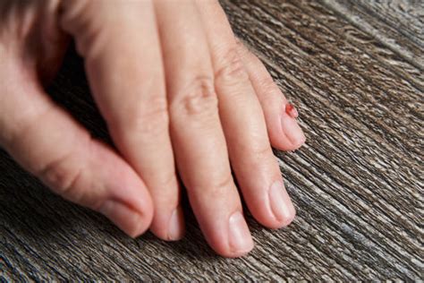 granuloma annulare stock  pictures royalty  images istock