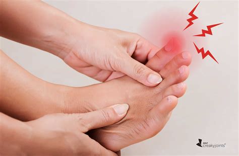 The Biologic Medication Kineret Is Effective for Gout Flares