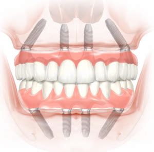 benefits  full arch dental implants bay area surgical arts