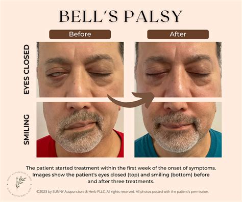 Treat Bell’s Palsy With Acupuncture — SUNNY Acupuncture & Herb