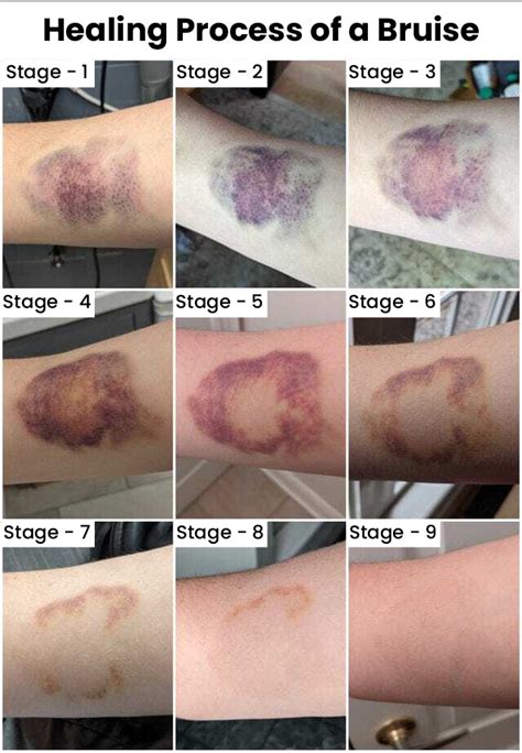 Reasons Behind Bleeding And Bruising During Cancer Treatment and Ways ...
