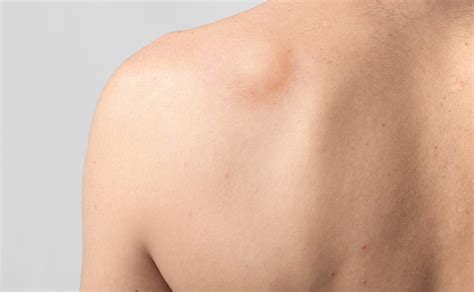 Lipoma Removal - Skin Surgery Clinic