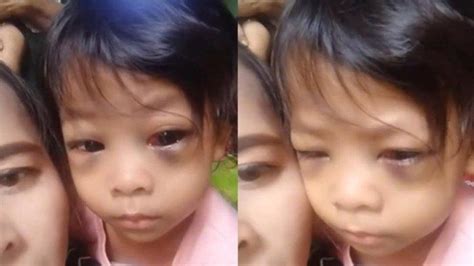 viral bocah alami iritasi mata parah gara gara keseringan main