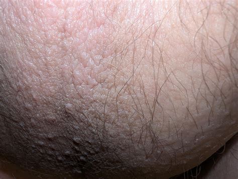 Skin Tag On Scrotum