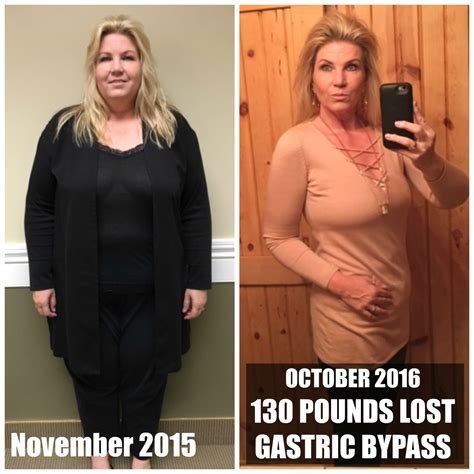 Terry S.’s Gastric Bypass Story