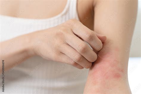 Sensitive skin allergic concept, Woman itching on her arm have a red ...