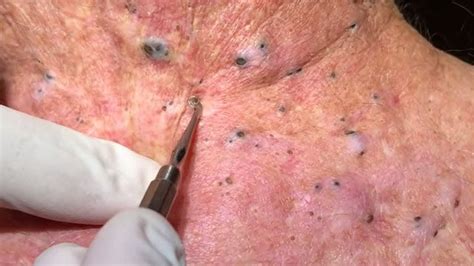 Unbelievable Blackhead Removal 2024: Frequently Asked Questions (FAQ) - z9hy69n