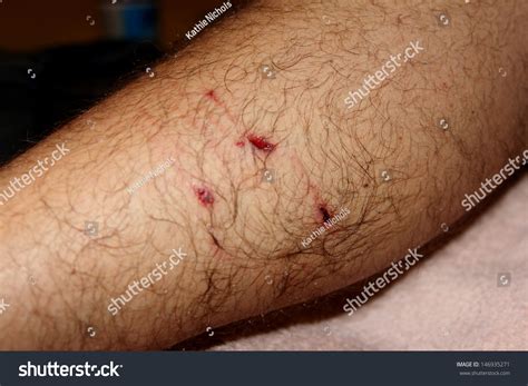 Dog Bite Wound 1 Stock Photo 146935271 - Shutterstock