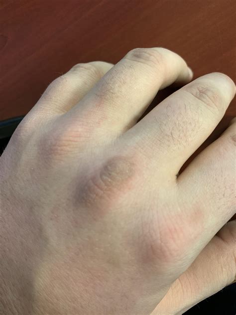 Have a callus-looking bump on my hand. What is it? Just a little darker