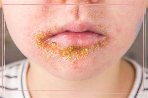 advice  impetigo  doctors  parents goodtoknow