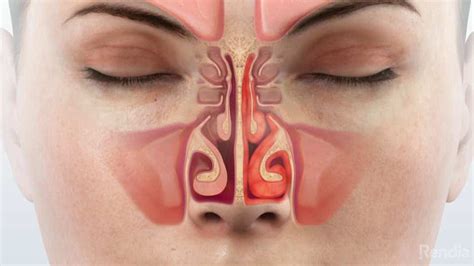 rhinitis overview entjc