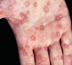 syphilis definition  syphilis