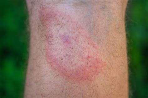 Tick Bite Symptoms | Outdoor Life