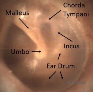 Normal Ear Drum Anatomy - WiscMed