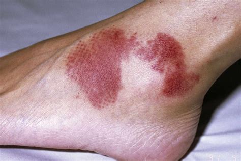 Petechiae vs. Purpura: Skin Discoloration and Your Health