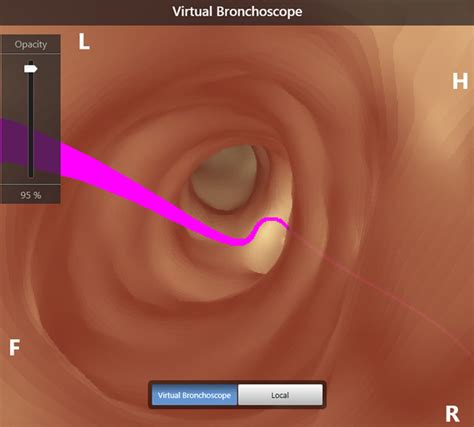 Virtual bronchoscopy: the preview allows the operator to visualize the ...