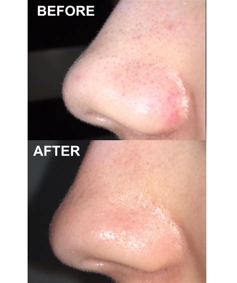 the effect of one month of accutane (40 mg) on nose : r/Accutane
