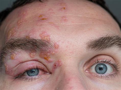 el picor  la hinchazon son desagradables pero lo peor es el dolor