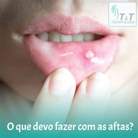 Afta Branca Na Lingua - O que devo fazer com as aftas? Você o que são as aftas? | Afta ...