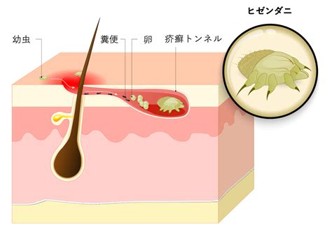疥癬見分け方 | 疥癬とは わかりやすく | 疥癬（かいせん） 東京都保健医療局 – FSML