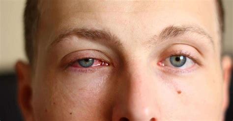 Common Eye Diseases: List of Most Common Eye Diseases in India ...