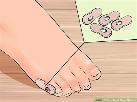 how to treat open blisters on feet