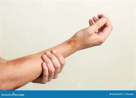 Раны на руке человека стоковое изображение. изображение насчитывающей ...