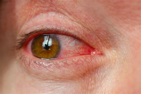 understanding red eye common   treatment eye clinic dubai