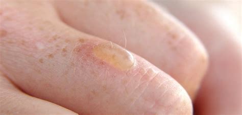 How To Cover A Burn Blister With Makeup - Mugeek Vidalondon