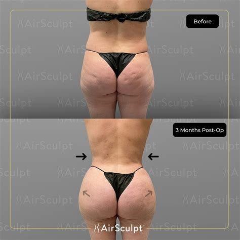 BBL vs. Butt Lift: How They Differ