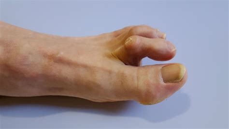 Hammer Toe Before And After
