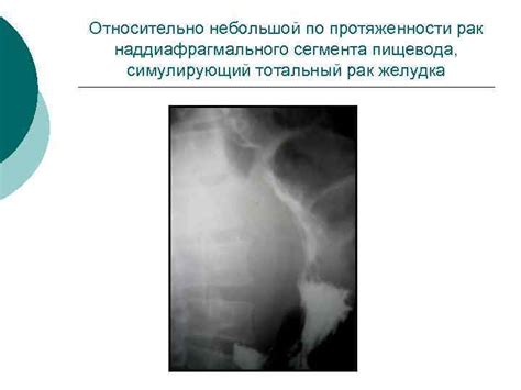 Рак пищевода и желудка Актуальность