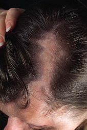 Morphea - Causes, Symptoms, Treatment - Derma.Wiki