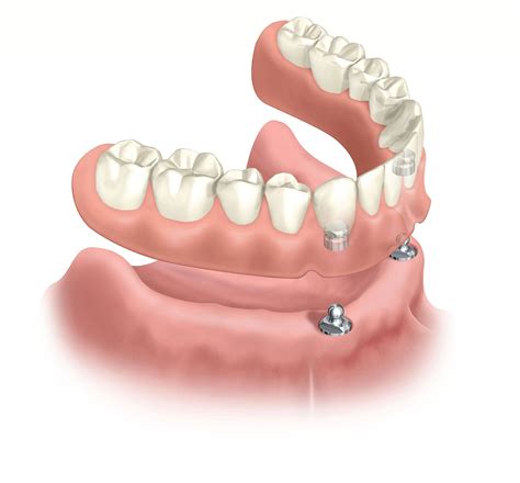 Pros and Cons of Snap-In Dentures | Rockville Dental Arts