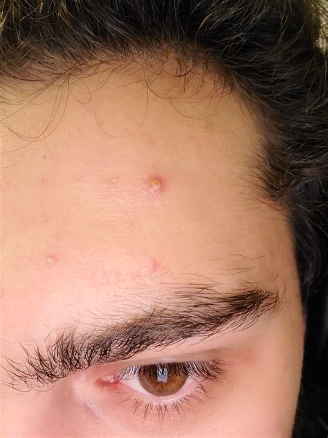 Giant Pimple On Forehead