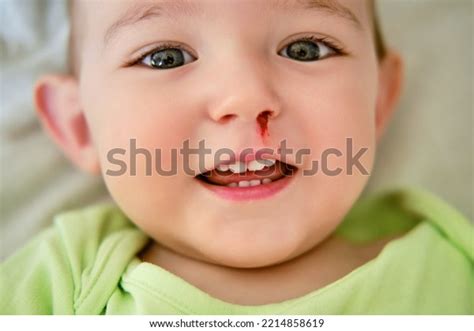 Happy Toddler Baby Boy Bloody Nose Stock Photo 2214858619 | Shutterstock