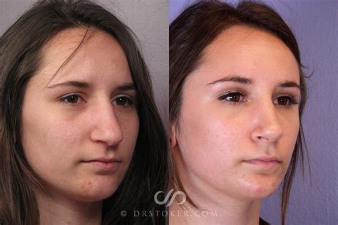 Septoplasty And Turbinate Reduction Before And After