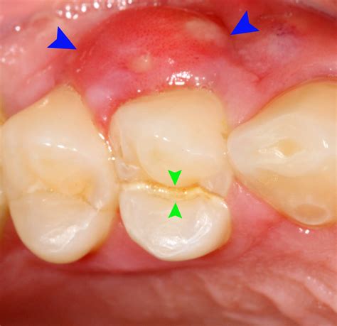 periodontal abscess | DentalDisaster.com