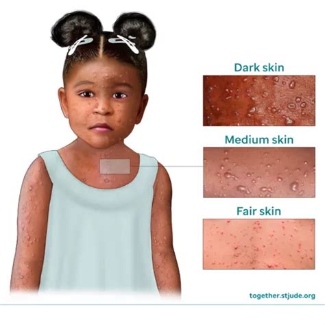 chicken pox stages infection