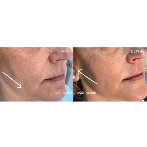 Preenchimento Maçã Do Rosto Antes E Depois - Clínica Médico Dentária 5 de Outubro - Preenchimento da Maçã do Rosto ...