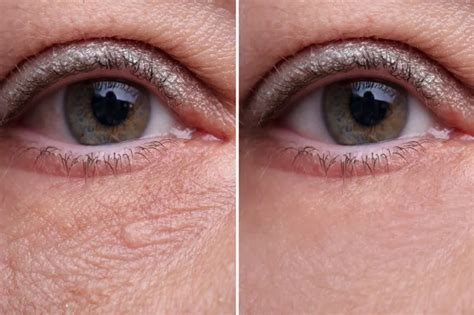 eye wrinkle treatments msymicom