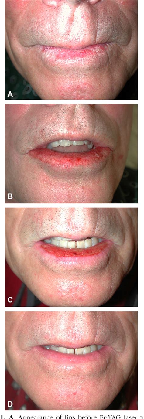 Actinic Cheilitis