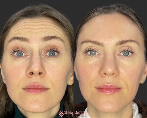 Botox Before and After Results - Everything You Need to See & Know