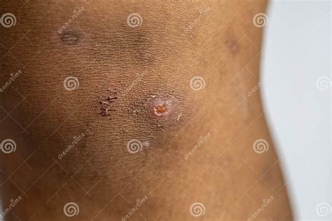 Atopic Dermatitis and Fungal Diseases on the Human Body. Editorial ...