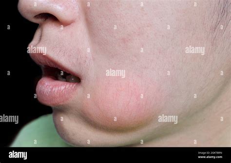 Mouth abscess hi-res stock photography and images - Alamy