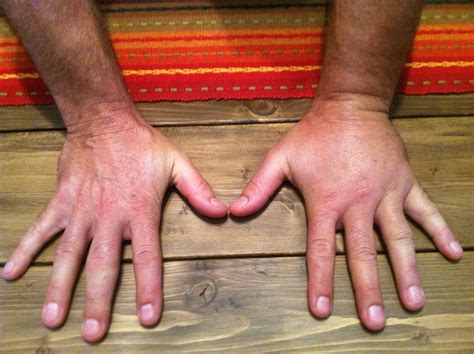 Home remedies for Yellow Jacket Stings - HealthNBodytips.org