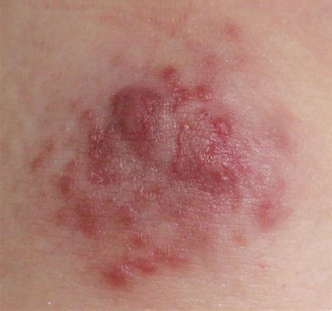 erythematous rash itchy  pruritic rash  pregnancy  bmj