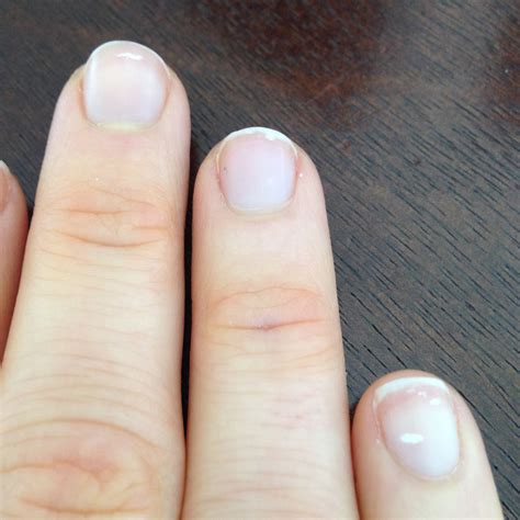 White Spots Under Fingernails