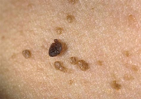 flat wart  seborrheic keratosis  paulette reynolds blog
